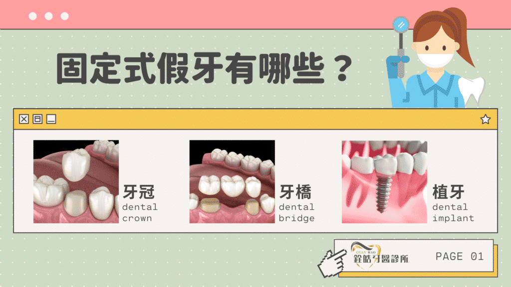 固定假牙價格差異這麼大是為什麼？一篇帶你搞懂所有固定式假牙種類，固定式假牙有哪些