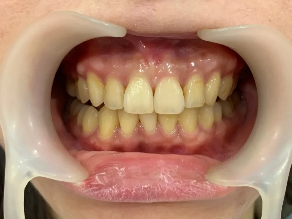 三重牙醫 隱形矯正案例1