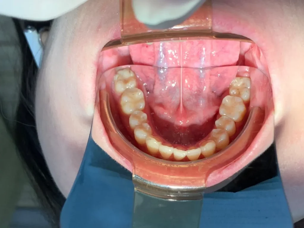 三重牙醫 隱形矯正案例2