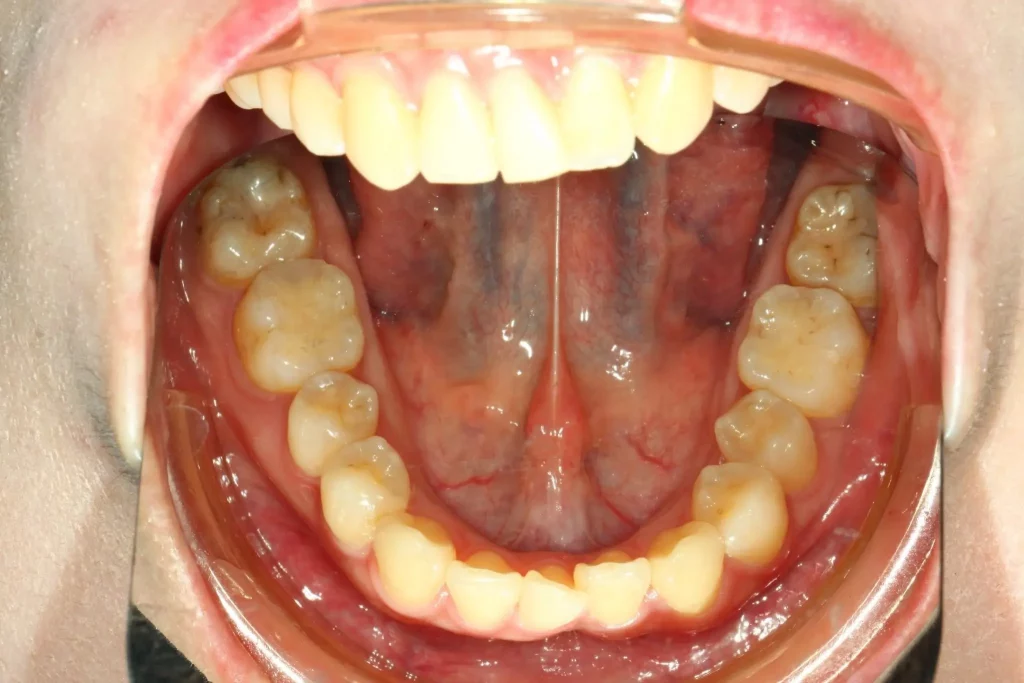 三重牙醫 隱形矯正案例3