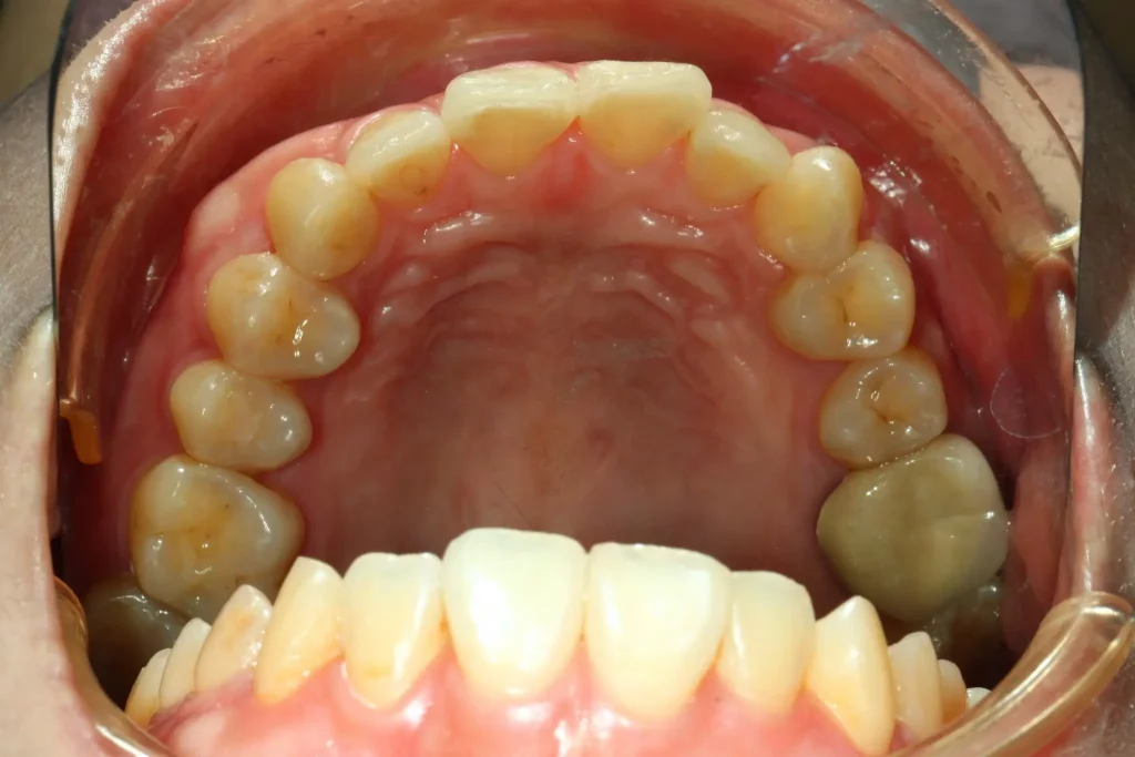 三重牙醫 隱形矯正案例4