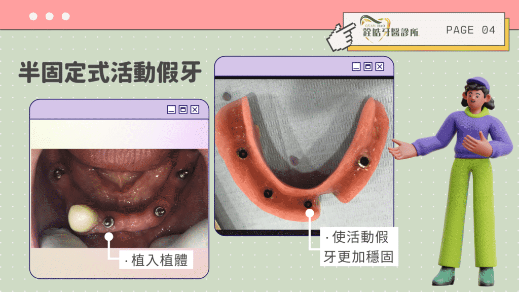 半固定式假牙