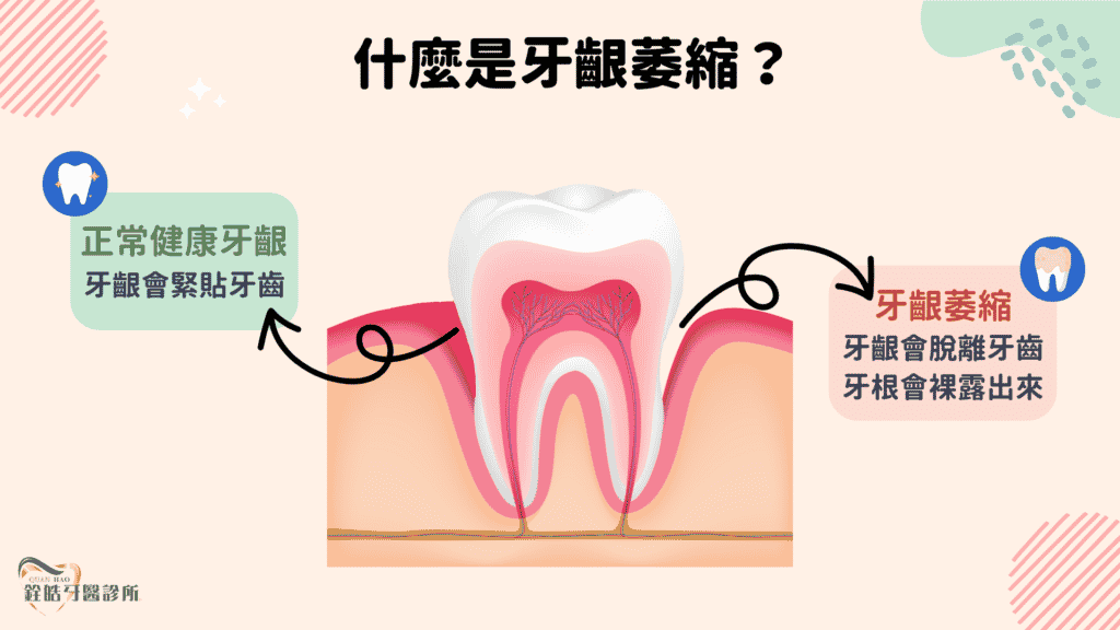 什麼是牙齦萎縮？