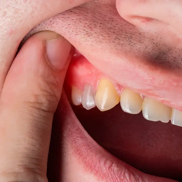 牙齒鬆動補救方法 牙周病示意圖