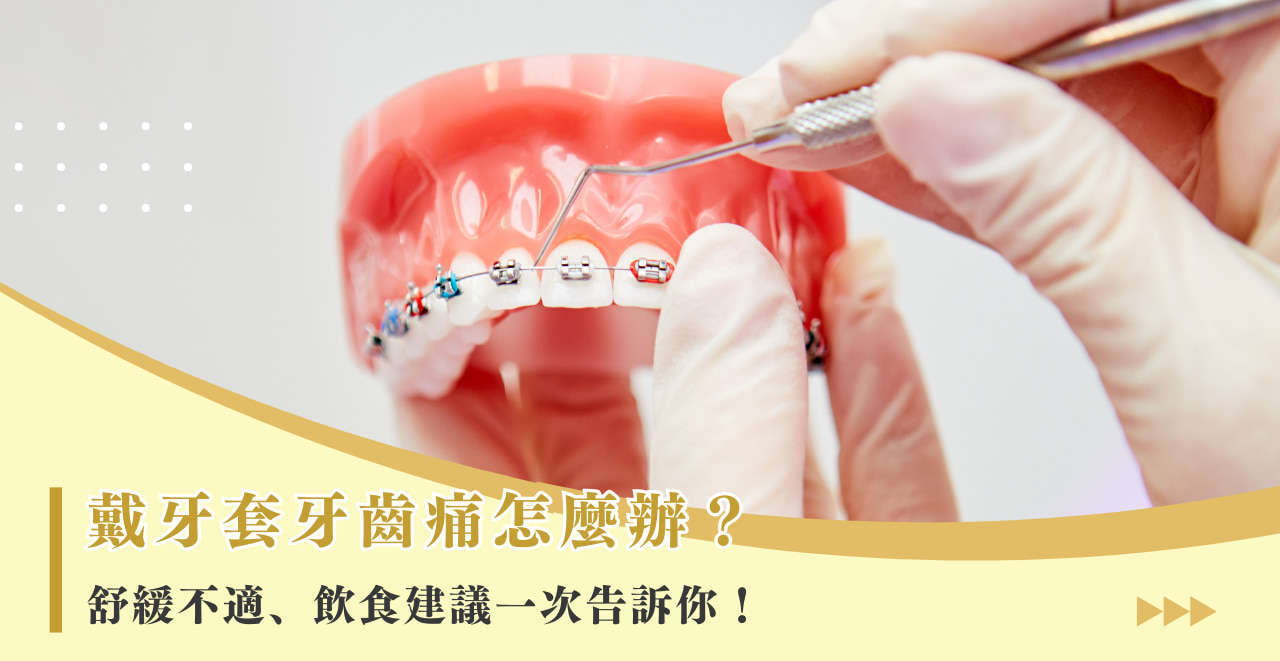 戴牙套牙齒痛怎麼辦？舒緩不適、飲食建議一次告訴你！