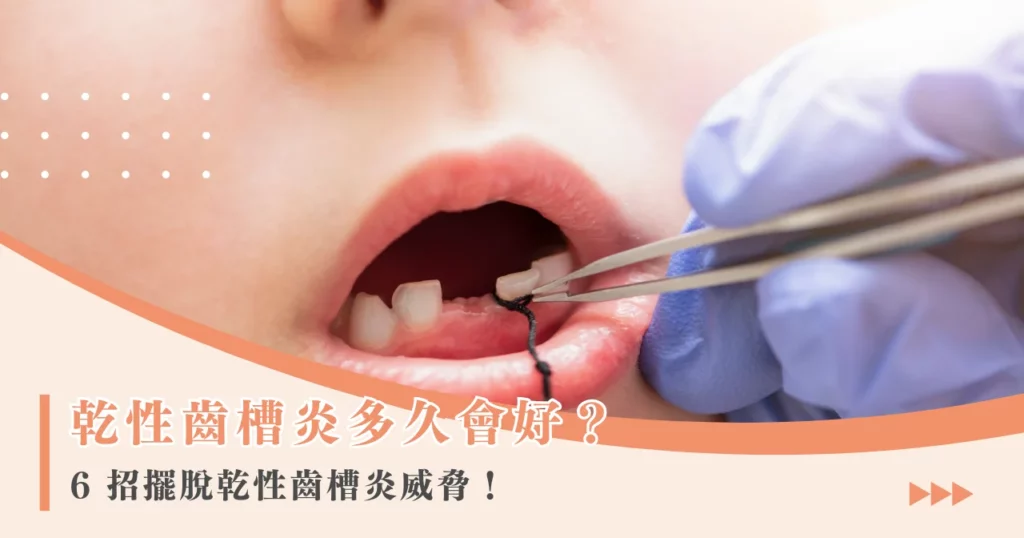 乾性齒槽炎多久會好? 6 招擺脫乾性齒槽炎威脅!