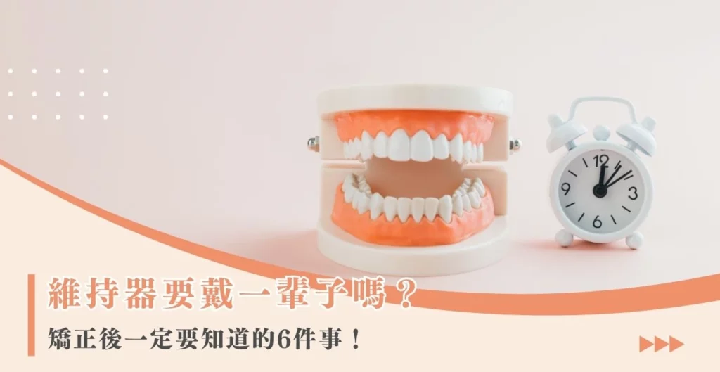 維持器要戴一輩子嗎？矯正後一定要知道的6件事！