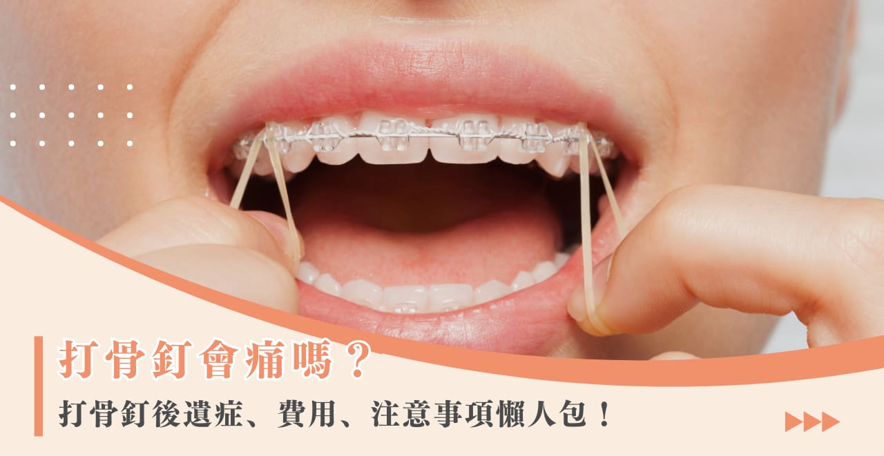 打骨釘會痛嗎？打骨釘後遺症、費用、注意事項懶人包！