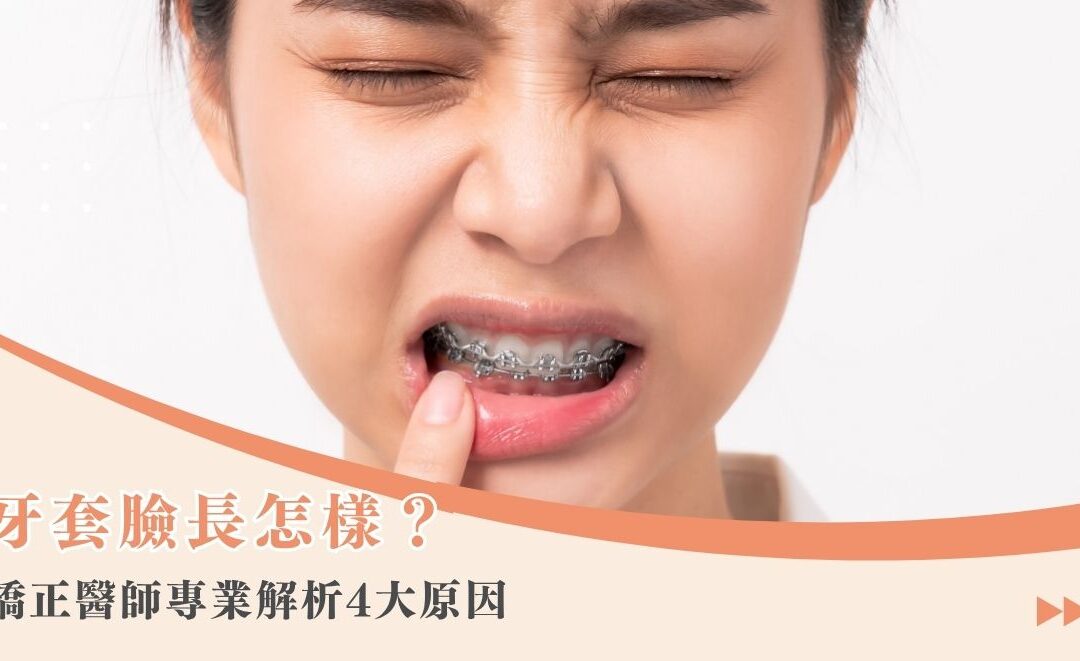 牙套臉長怎樣？矯正醫師專業解析 4 大原因