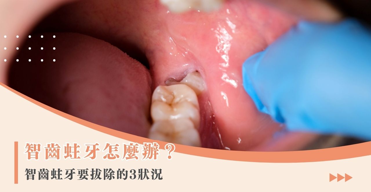 智齒蛀牙怎麼辦？智齒蛀牙要拔除的 3 狀況
