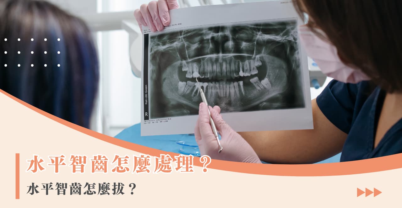 水平智齒怎麼處理？水平智齒怎麼拔？